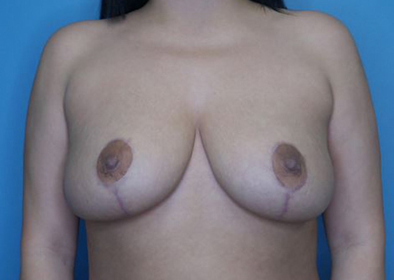 Breast Reduction Before & After Gallery - Patient 170650137 - Image 2