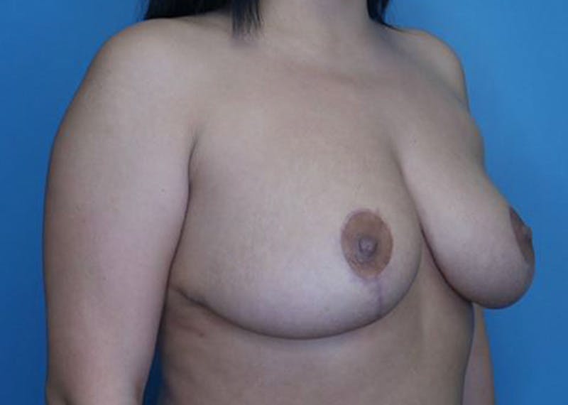 Breast Reduction Before & After Gallery - Patient 170650137 - Image 4