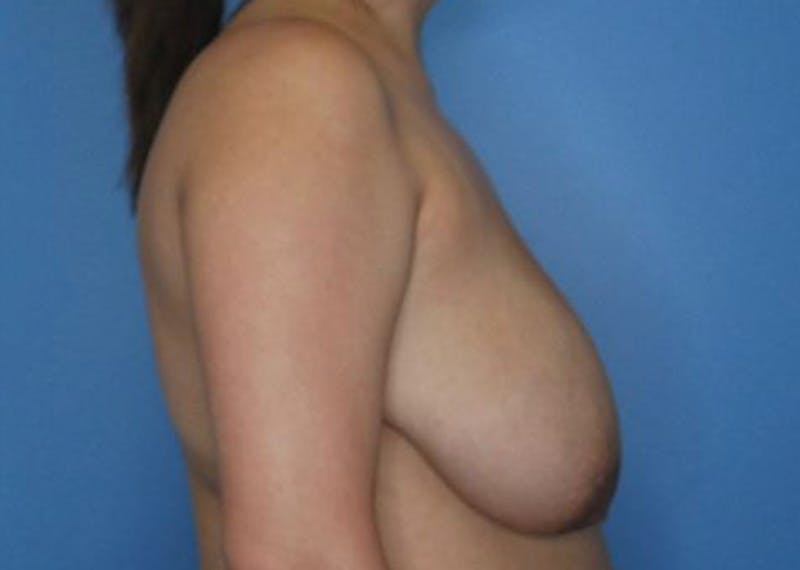 Breast Reduction Before & After Gallery - Patient 170650137 - Image 5