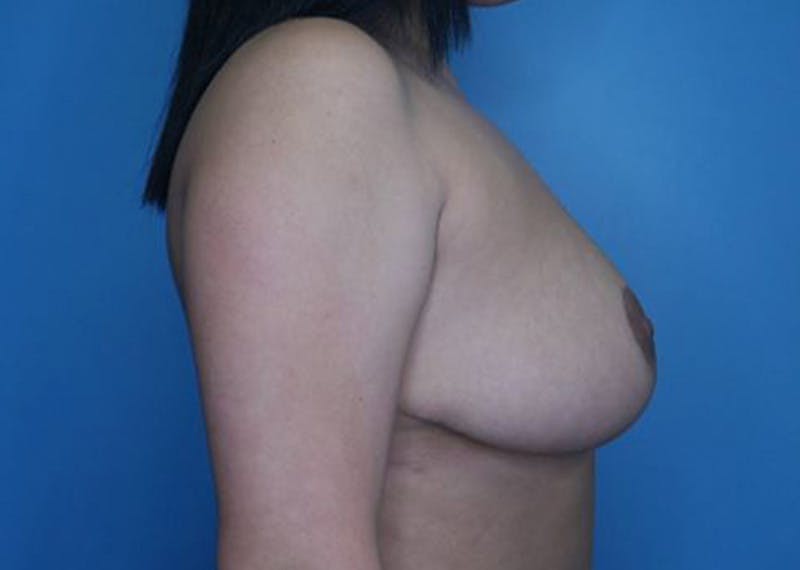Breast Reduction Before & After Gallery - Patient 170650137 - Image 6