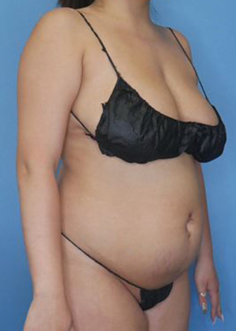 Vaser Liposuction Before & After Gallery - Patient 170650138 - Image 1