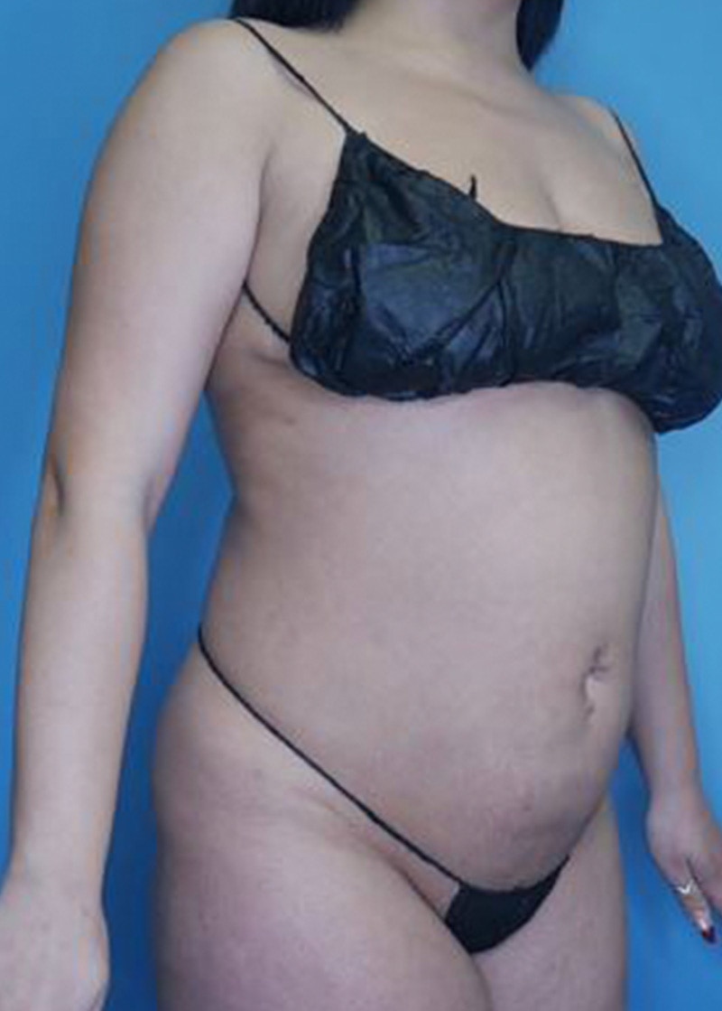Vaser Liposuction Before & After Gallery - Patient 170650138 - Image 2