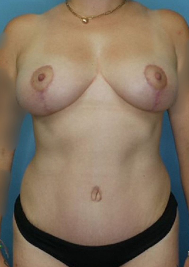 Mommy Makeover Before & After Gallery - Patient 170650198 - Image 2