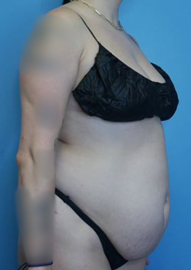 Mommy Makeover Before & After Gallery - Patient 170650198 - Image 3