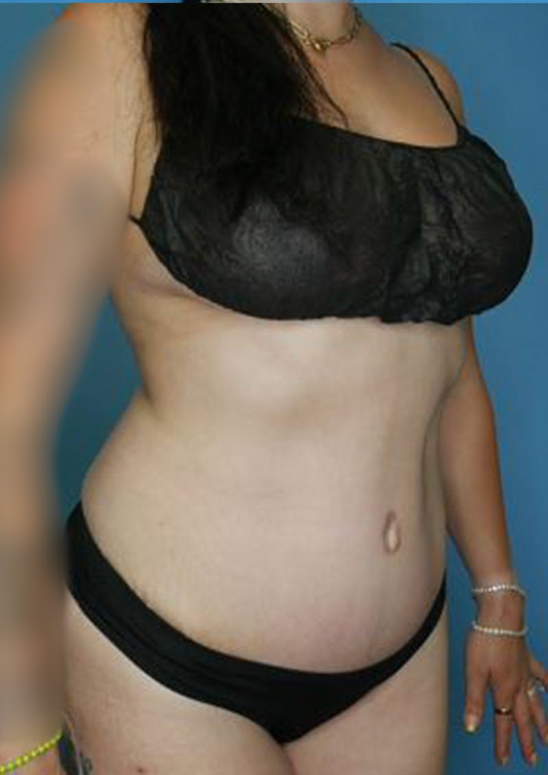 Mommy Makeover Before & After Gallery - Patient 170650198 - Image 4