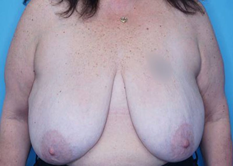 Breast Reduction Before & After Gallery - Patient 172172991 - Image 1
