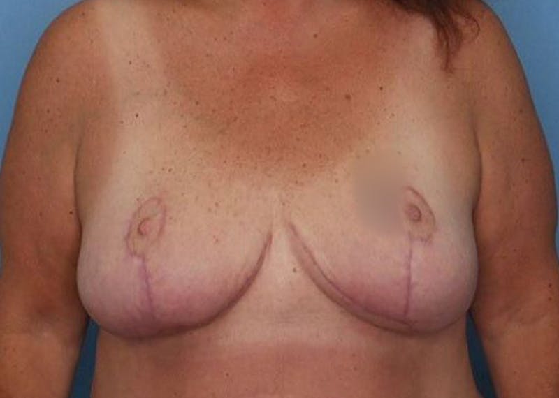 Breast Reduction Before & After Gallery - Patient 172172991 - Image 2