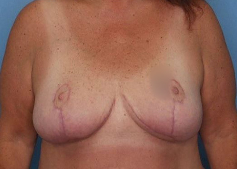 Breast Reduction Before & After Gallery - Patient 172172991 - Image 2
