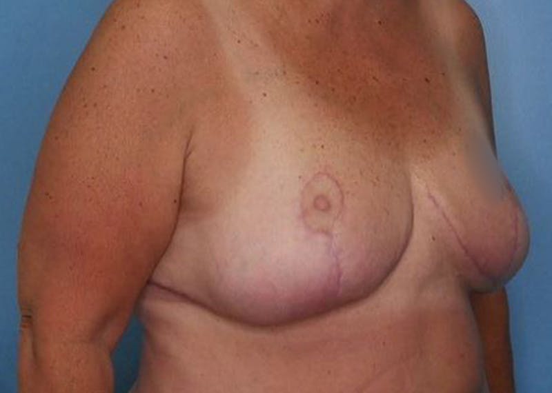 Breast Reduction Before & After Gallery - Patient 172172991 - Image 4
