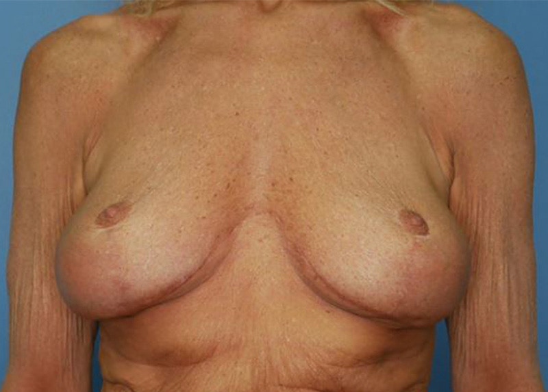 Breast Lift Before & After Gallery - Patient 172172994 - Image 1