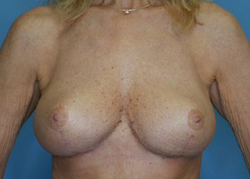 Breast Lift Before & After Gallery - Patient 172172994 - Image 2