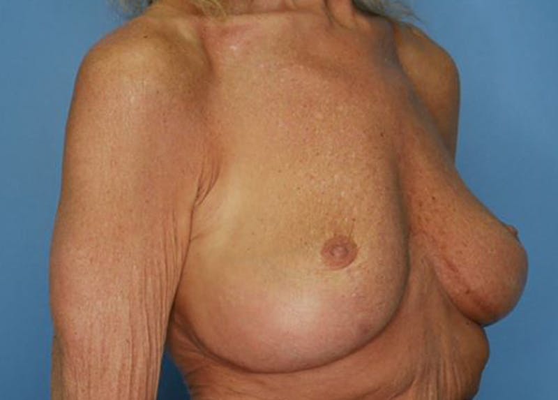 Breast Lift Before & After Gallery - Patient 172172994 - Image 3