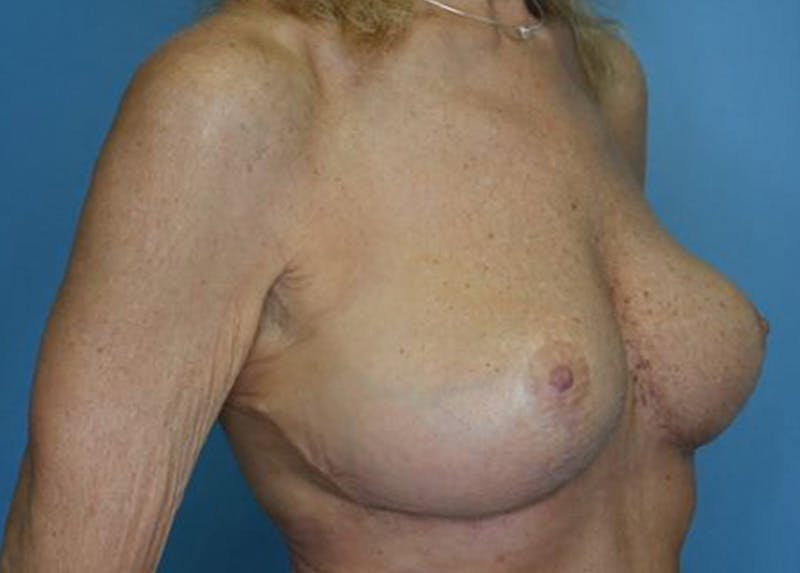 Breast Lift Before & After Gallery - Patient 172172994 - Image 4