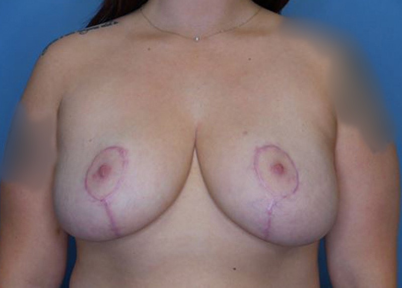 Breast Lift Before & After Gallery - Patient 172173006 - Image 2