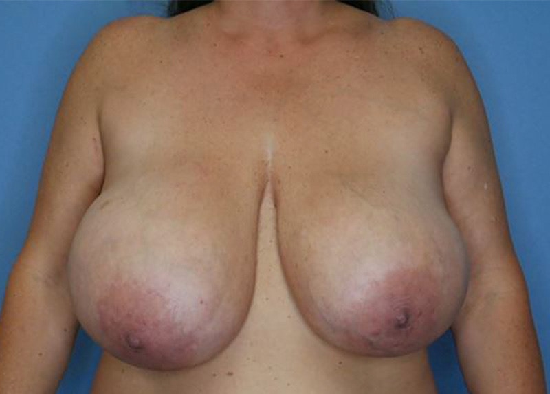 Breast Lift Before & After Gallery - Patient 172178703 - Image 1