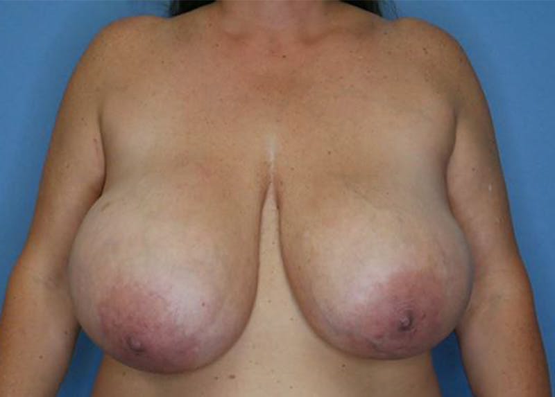 Breast Lift Before & After Gallery - Patient 172178703 - Image 1