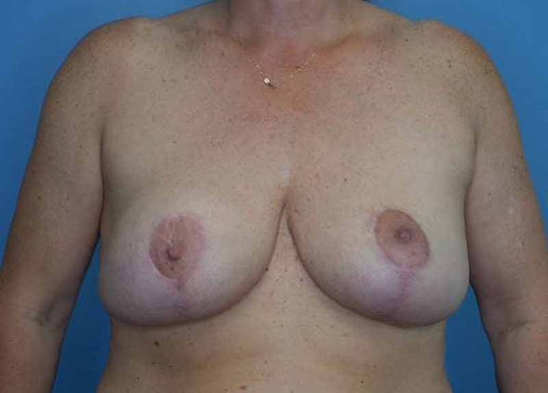 Breast Lift Before & After Gallery - Patient 172178703 - Image 2