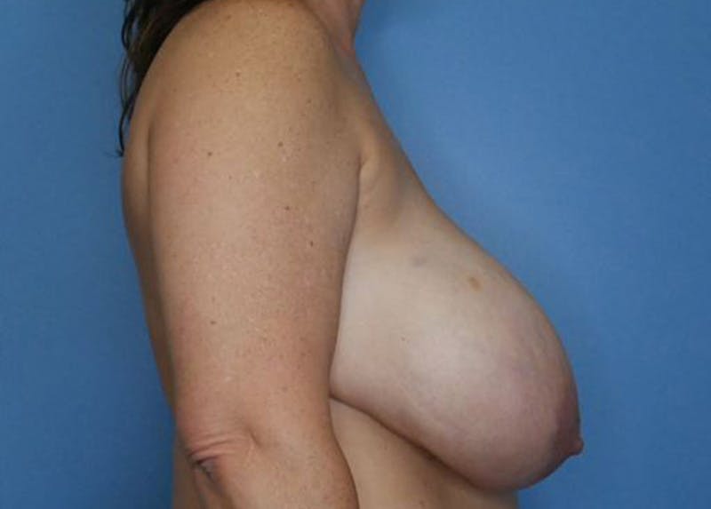 Breast Lift Before & After Gallery - Patient 172178703 - Image 3