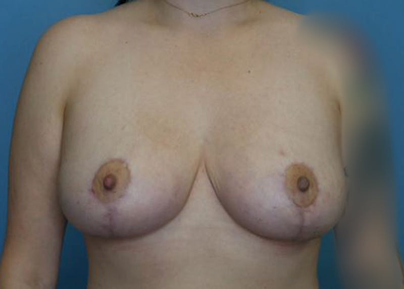 Breast Lift Before & After Gallery - Patient 172178724 - Image 2