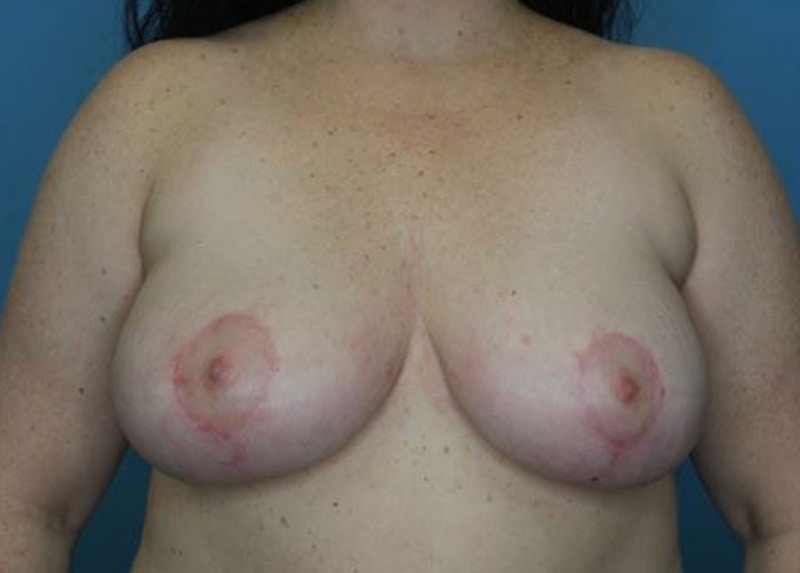 Breast Lift Before & After Gallery - Patient 172178751 - Image 2