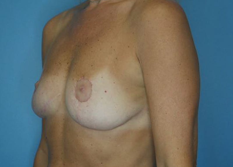Breast Lift Before & After Gallery - Patient 172178798 - Image 4