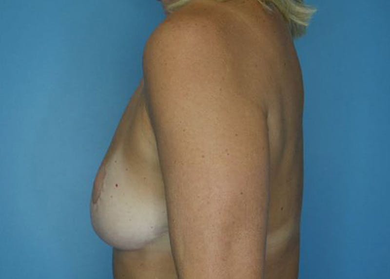 Breast Lift Before & After Gallery - Patient 172178798 - Image 5