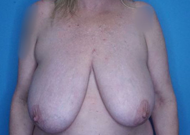 Breast Reduction Before & After Gallery - Patient 172178800 - Image 1