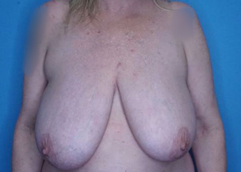 Breast Reduction Before & After Gallery - Patient 172178800 - Image 1