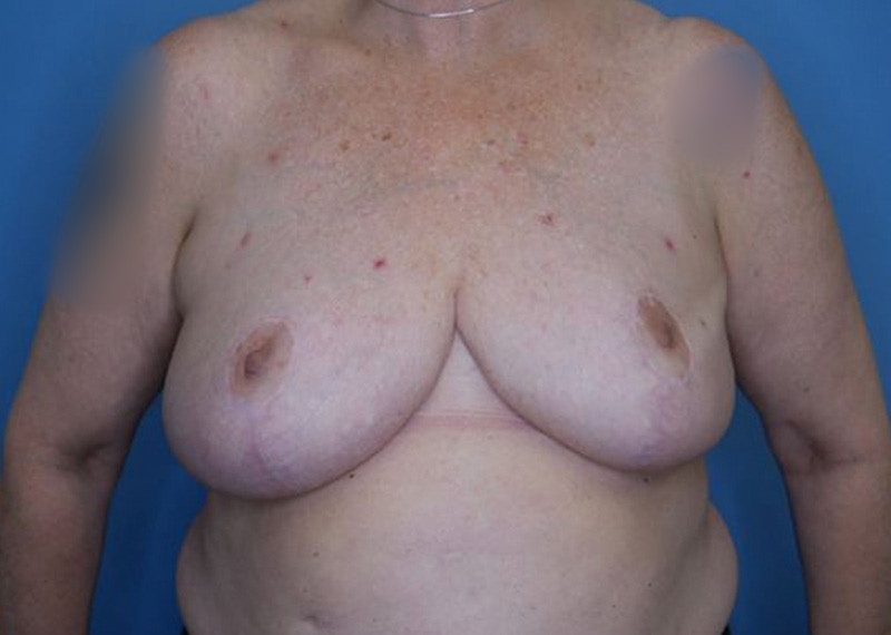 Breast Reduction Before & After Gallery - Patient 172178800 - Image 2