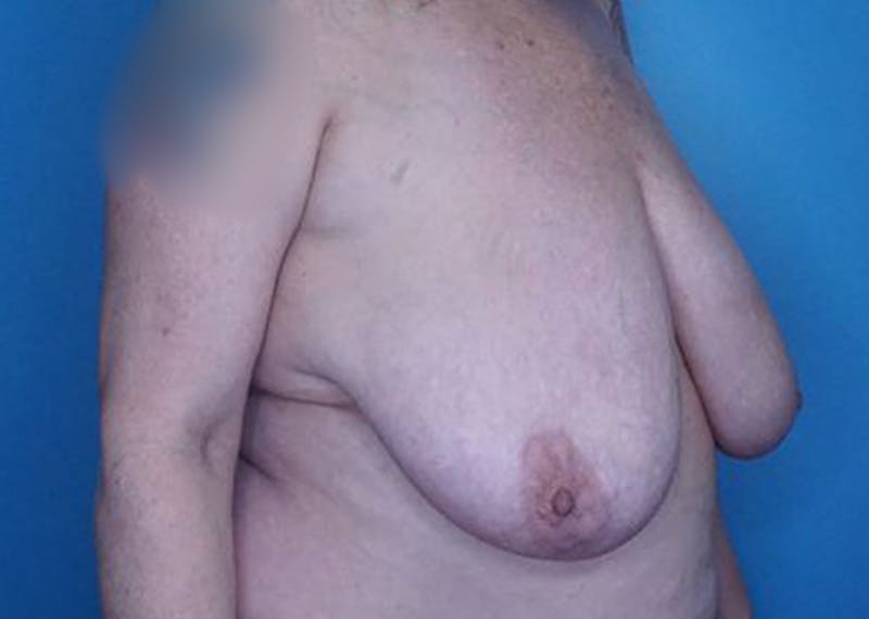 Breast Reduction Before & After Gallery - Patient 172178800 - Image 3