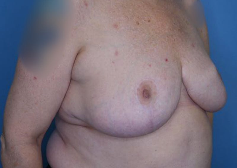 Breast Reduction Before & After Gallery - Patient 172178800 - Image 4
