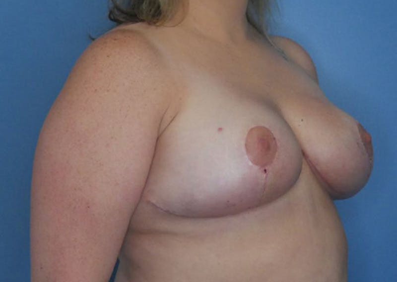Breast Reduction Before & After Gallery - Patient 172178839 - Image 4