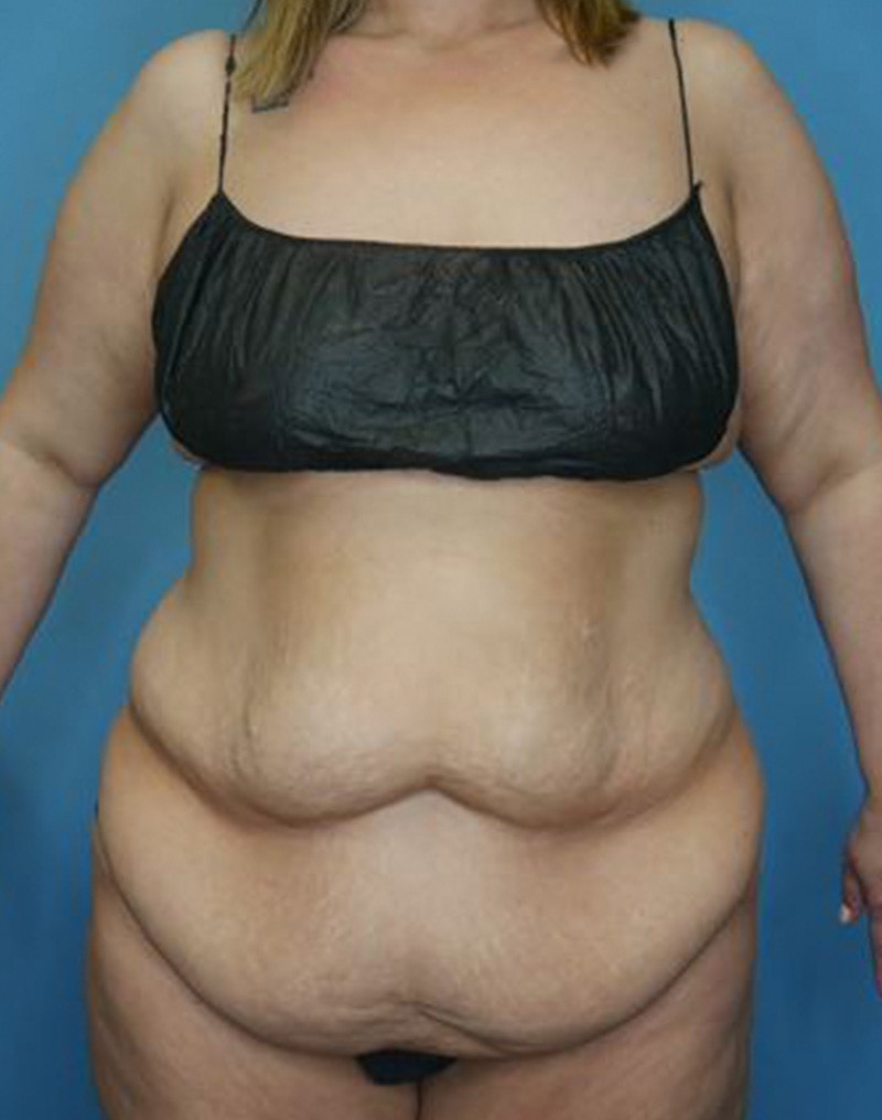 Tummy Tuck (Abdominoplasty)  Before & After Gallery - Patient 173920927 - Image 1