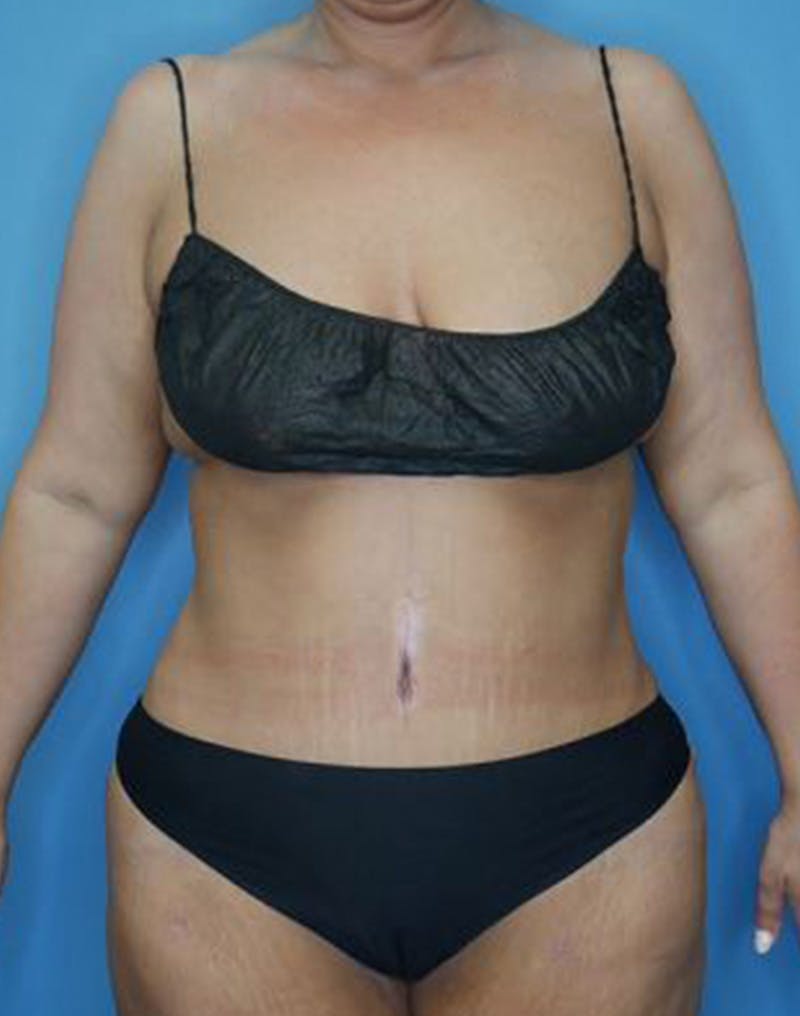 Tummy Tuck (Abdominoplasty)  Before & After Gallery - Patient 173920927 - Image 2