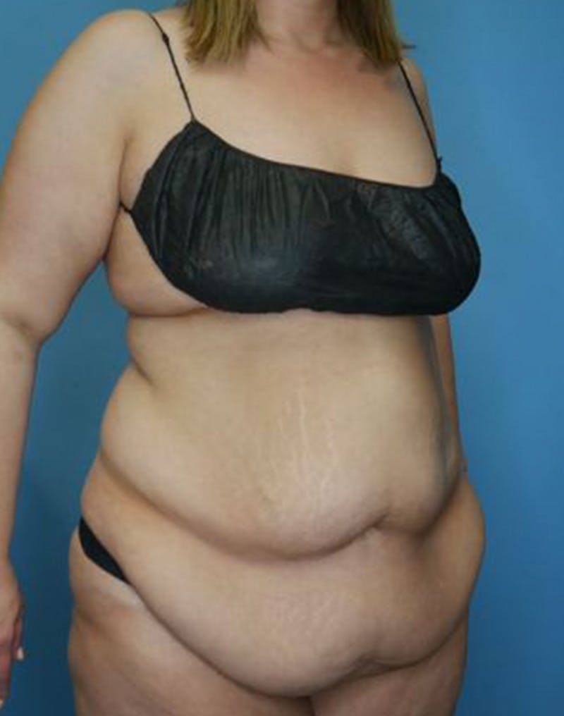 Tummy Tuck (Abdominoplasty)  Before & After Gallery - Patient 173920927 - Image 3