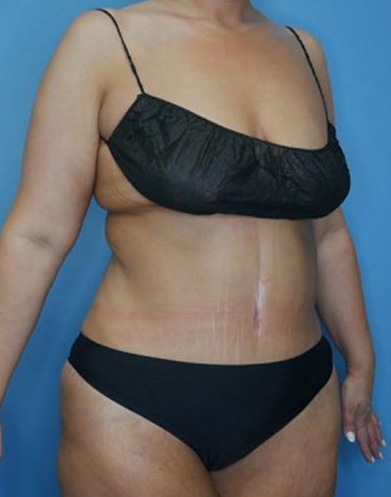 Tummy Tuck (Abdominoplasty)  Before & After Gallery - Patient 173920927 - Image 4
