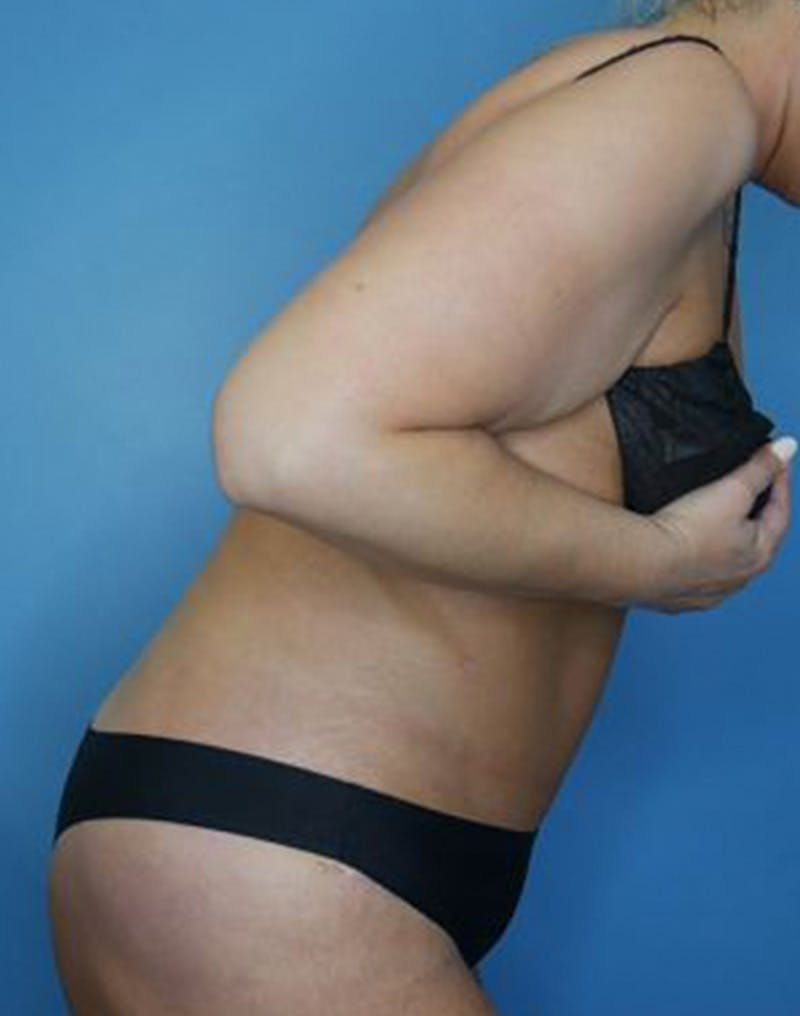 Tummy Tuck (Abdominoplasty)  Before & After Gallery - Patient 173920927 - Image 6