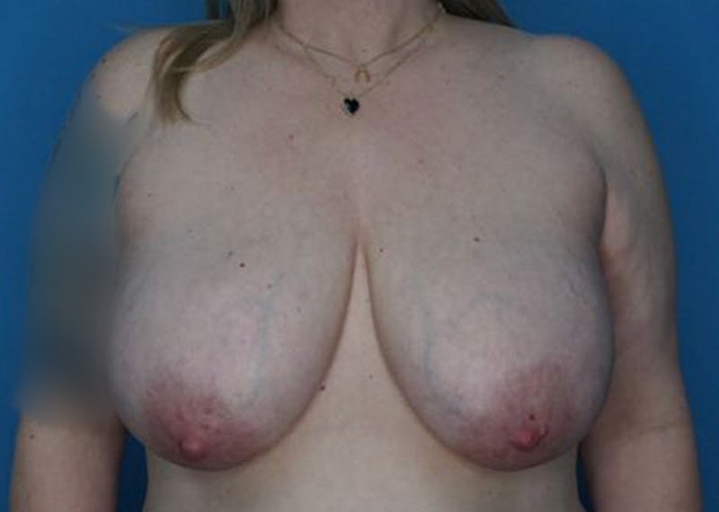 Breast Lift Before & After Gallery - Patient 174193955 - Image 1