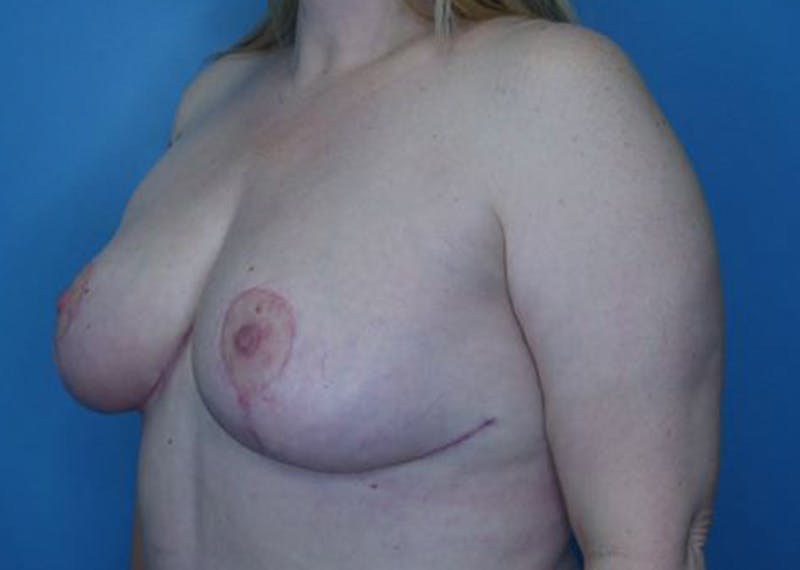Breast Reduction Before & After Gallery - Patient 174193954 - Image 4