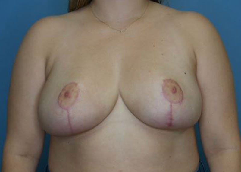 Breast Lift Before & After Gallery - Patient 174194069 - Image 2