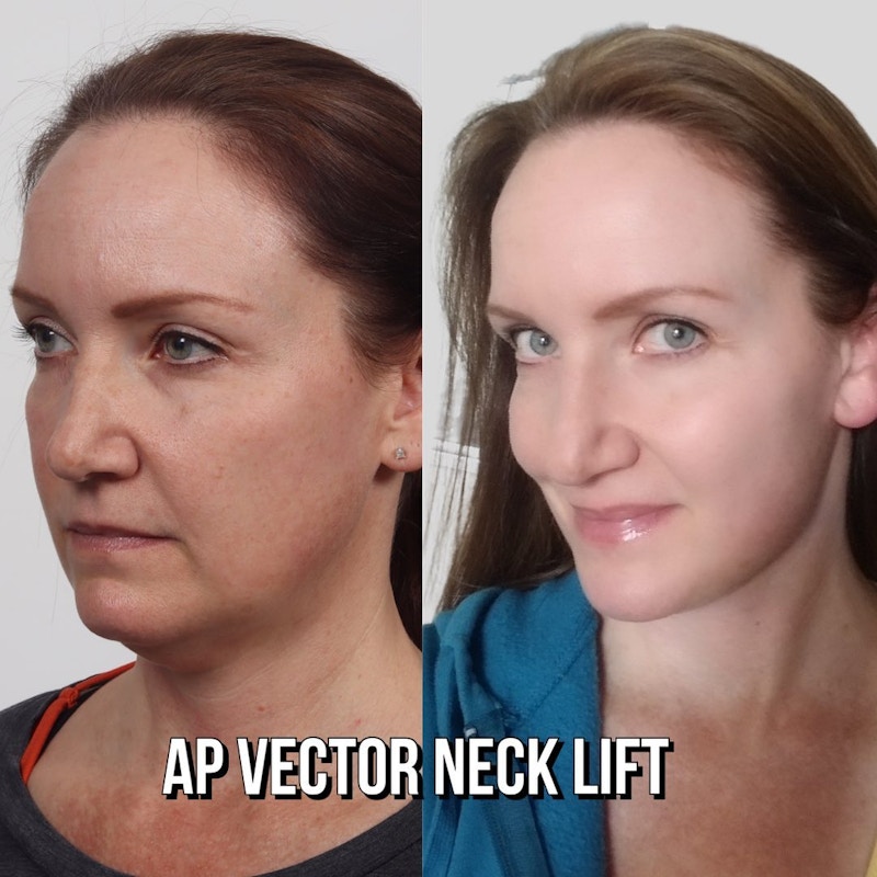 Deep Neck Lift Before & After Gallery - Patient 177056534 - Image 1