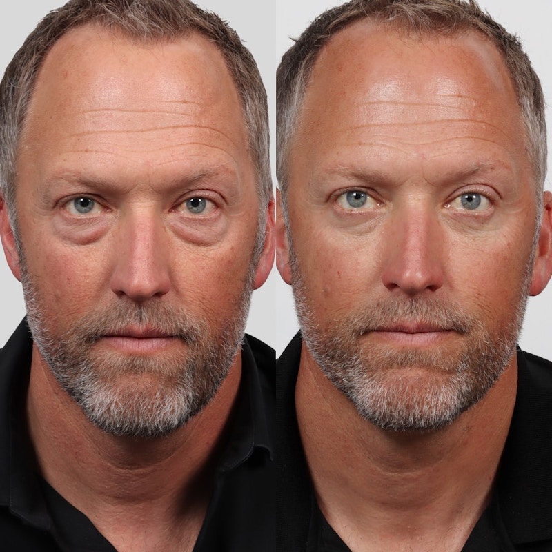 Eyelid Surgery (Blepharoplasty) Before & After Gallery - Patient 177056535 - Image 1