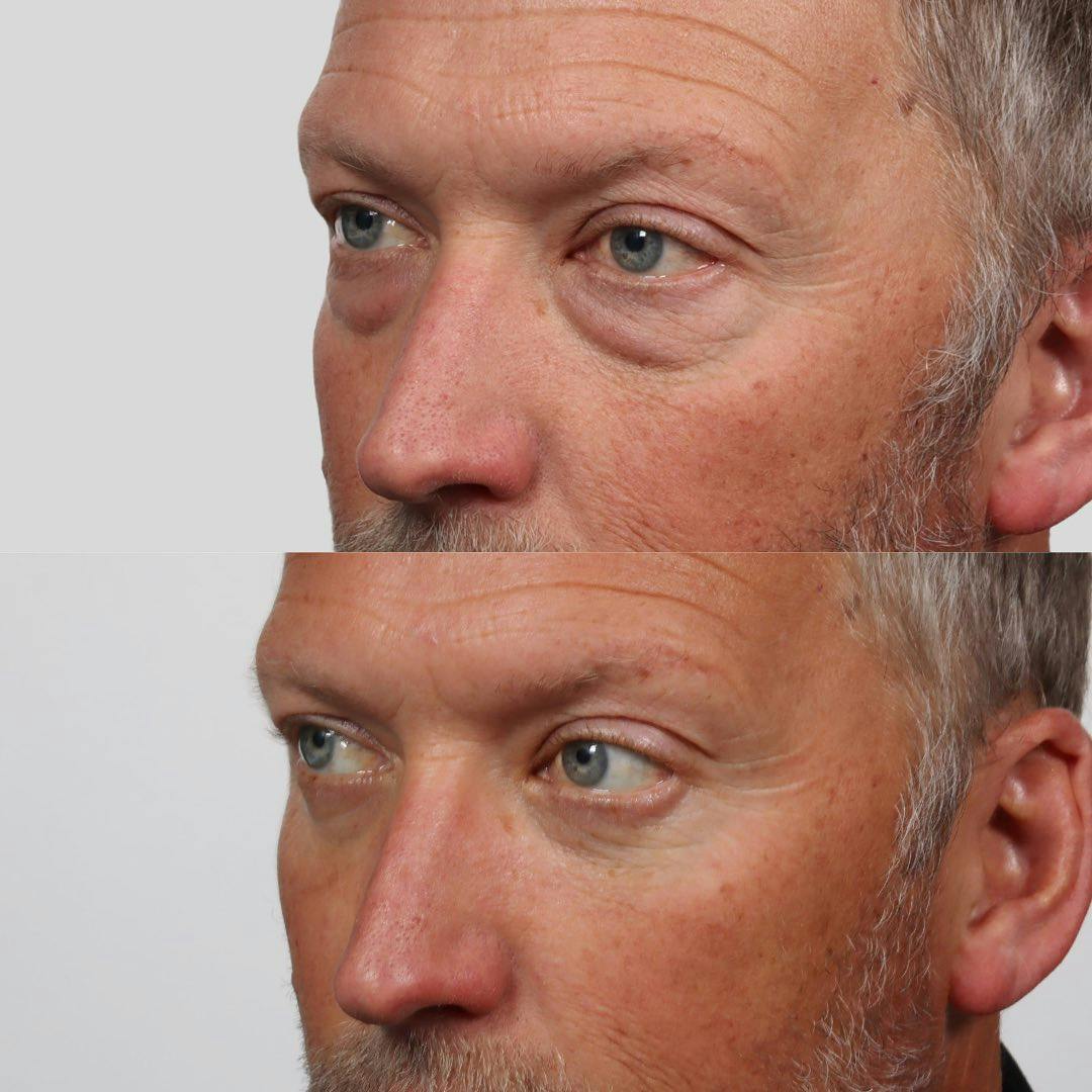 Eyelid Surgery (Blepharoplasty) Before & After Gallery - Patient 177056535 - Image 2