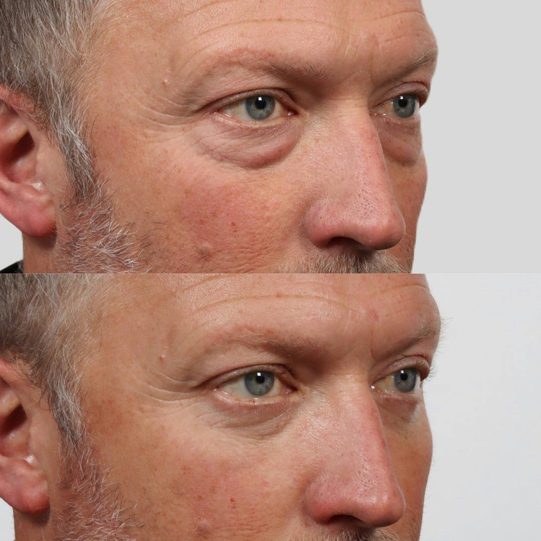 Eyelid Surgery (Blepharoplasty) Before & After Gallery - Patient 177056535 - Image 3