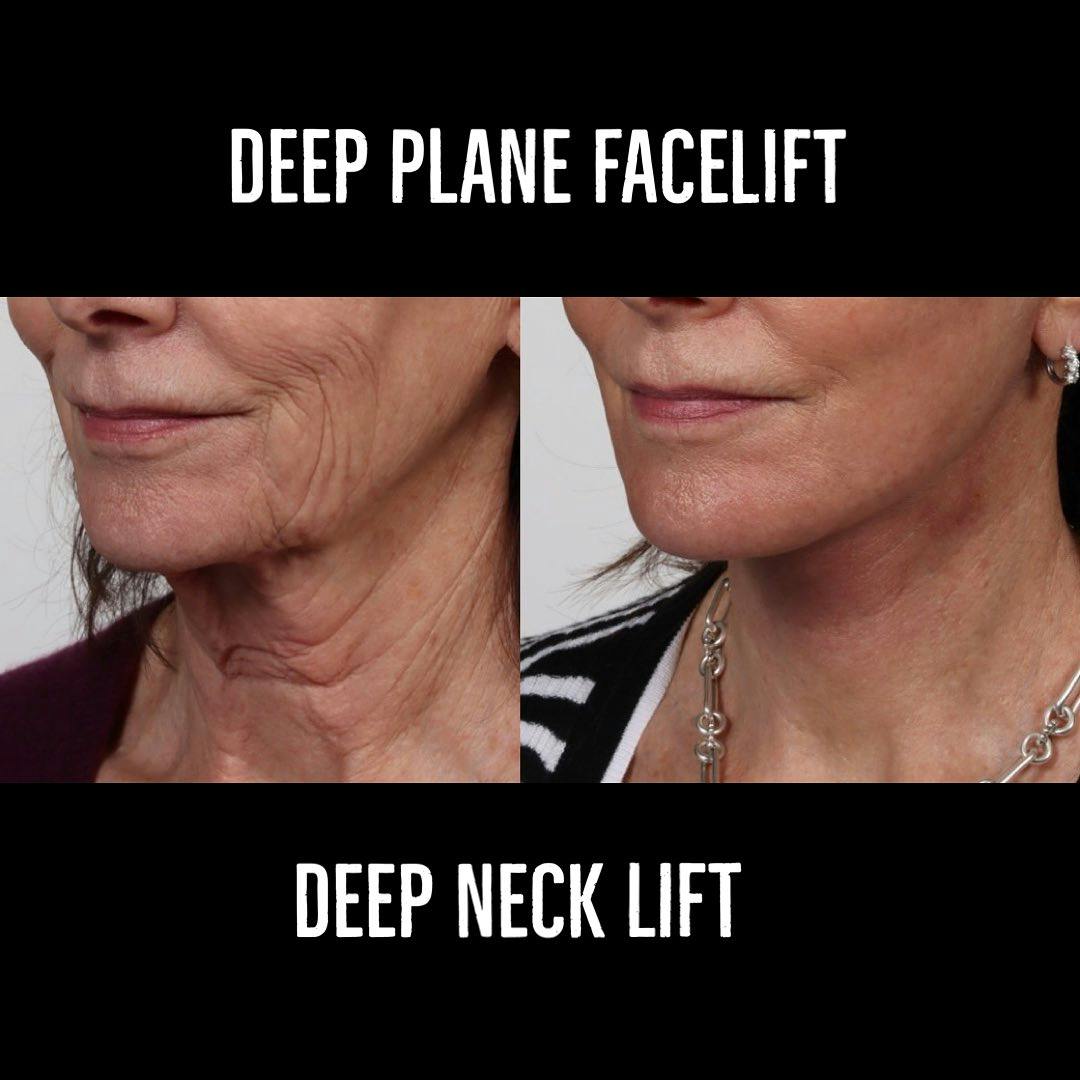 Deep Plane Facelift Before & After Gallery - Patient 177056538 - Image 1