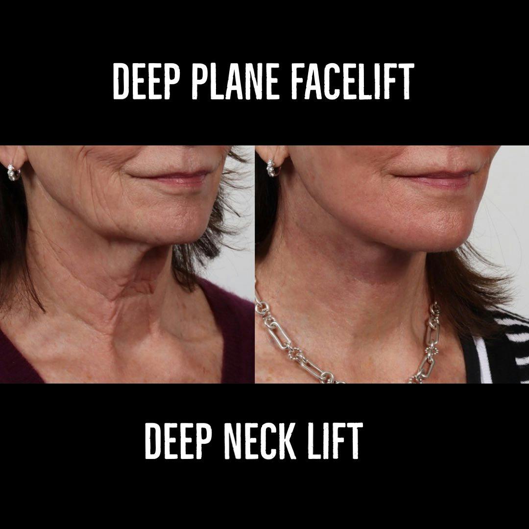 Deep Plane Facelift Before & After Gallery - Patient 177056538 - Image 2