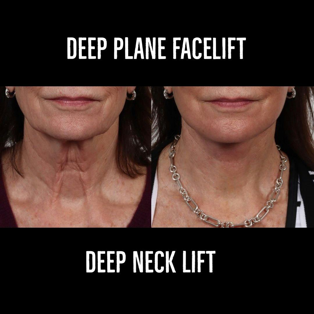 Deep Plane Facelift Before & After Gallery - Patient 177056538 - Image 3