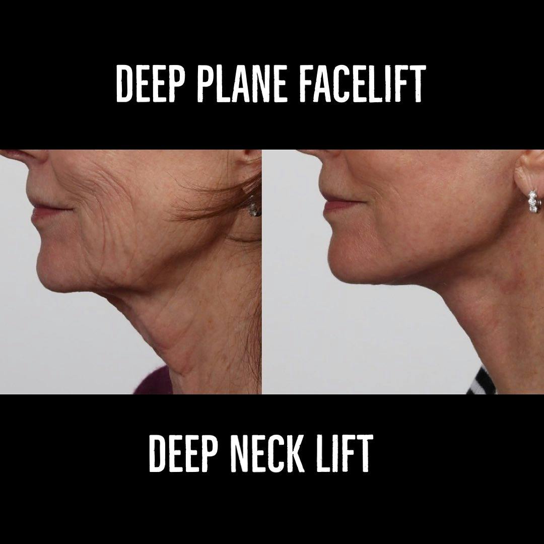Deep Plane Facelift Before & After Gallery - Patient 177056538 - Image 4