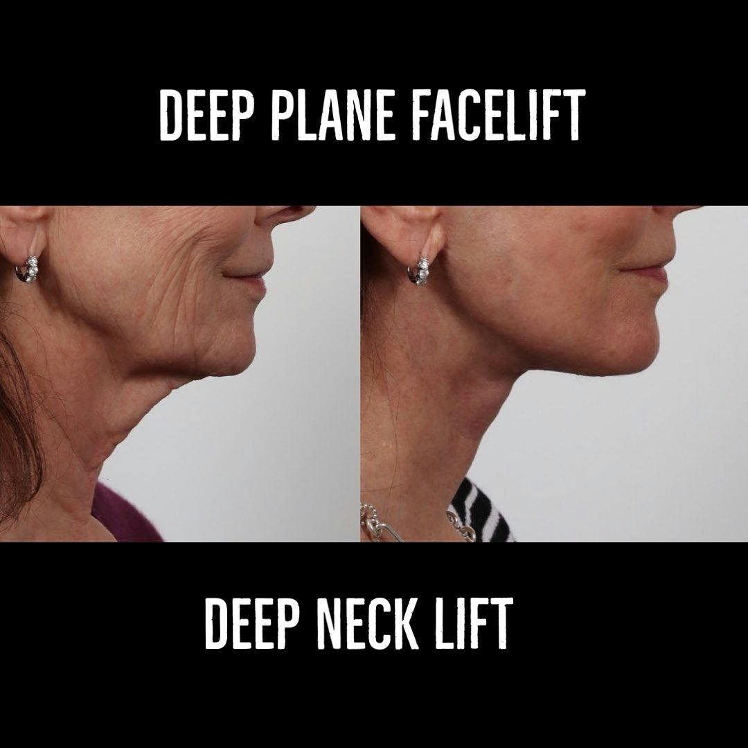 Deep Plane Facelift Before & After Gallery - Patient 177056538 - Image 5