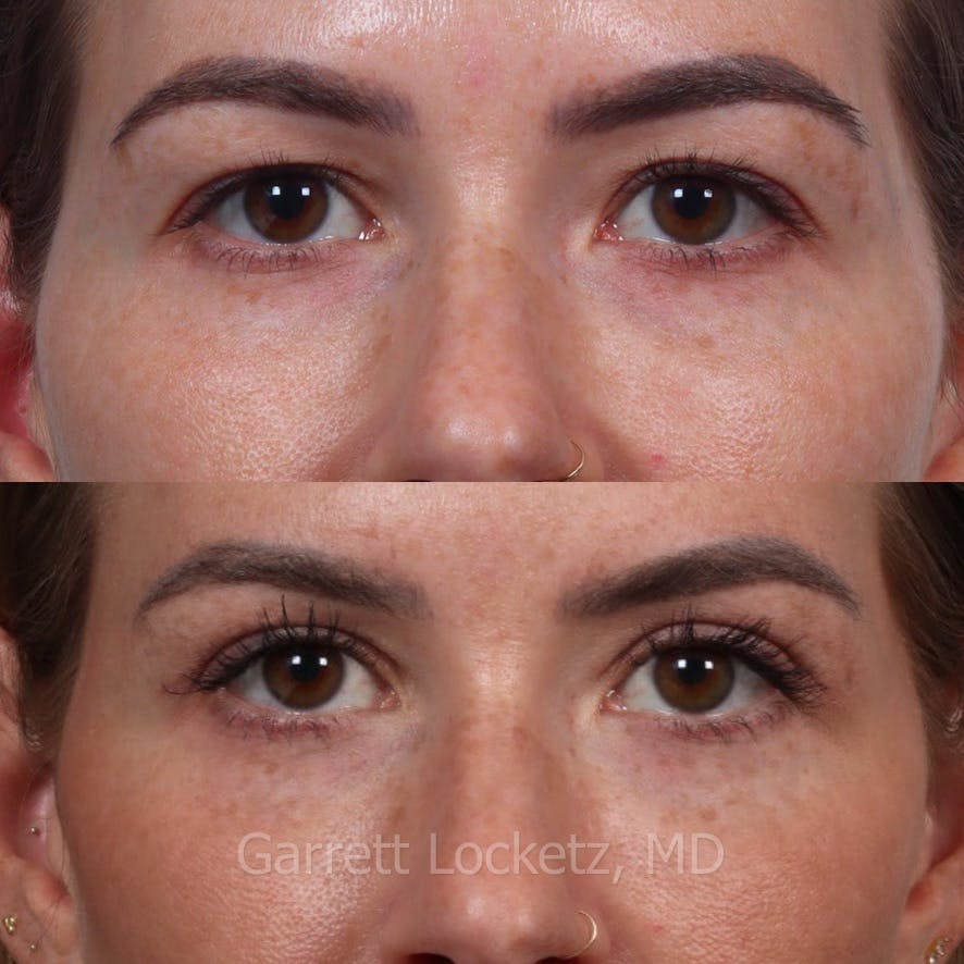 Eyelid Surgery (Blepharoplasty) Before & After Gallery - Patient 196499745 - Image 1